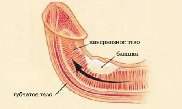 Врожденное искривление полового члена