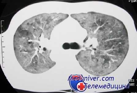 легочная вентиляция