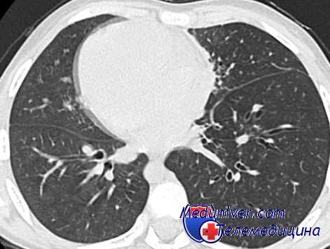 операция на легком