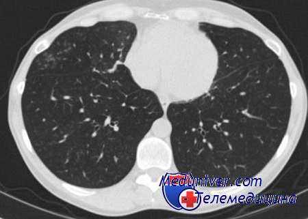 туберкулез