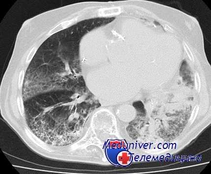 легочная вентиляция