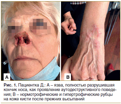 Рис. 1. Пациентка Д.: А - язва, полностью разрушившая кончик носа, как проявление аутодеструктивного поведения; В - нормотрофические и гипертрофические рубцы на коже кисти после прежних высыпаний