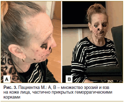 Рис. 3. Пациентка М.: А, В - множество эрозий и язв на коже лица, частично прикрытых геморрагическими корками