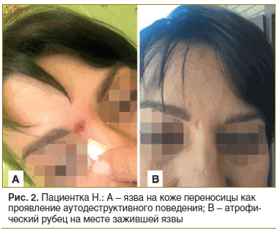 Рис. 2. Пациентка Н.: А - язва на коже переносицы как проявление аутодеструктивного поведения; В - атрофический рубец на месте зажившей язвы