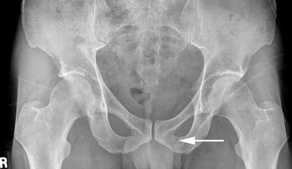 Рентгенография тазобедренного сустава: для чего проводится
