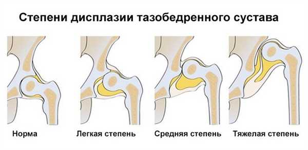 Рентгенография тазобедренного сустава: для чего проводится