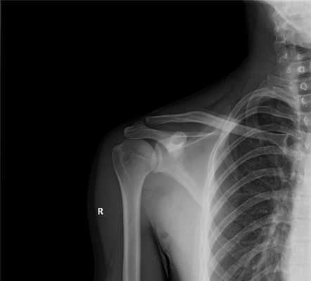 Рентген-исследование плечевого сустава.jpg
