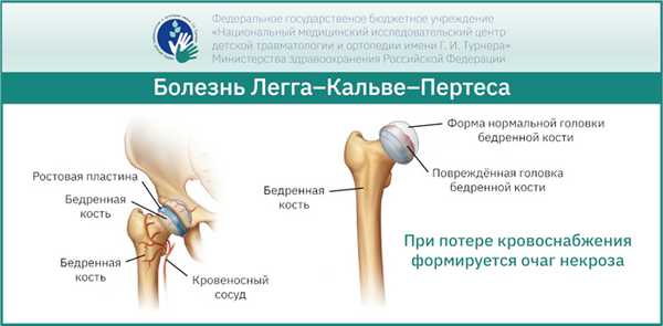 Болезнь Легга-Кальве-Пертеса — диагностика, лечение, причины и стадии развития