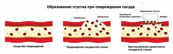 повреждение сосуда.jpg