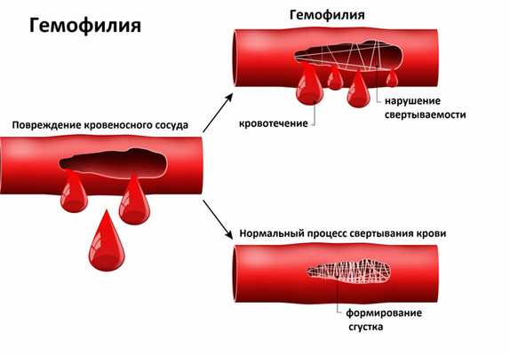 гемофилия.jpg