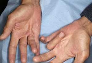 Синкинезии