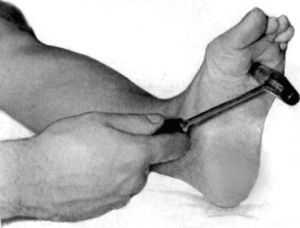 Рефлекс оппенгейма