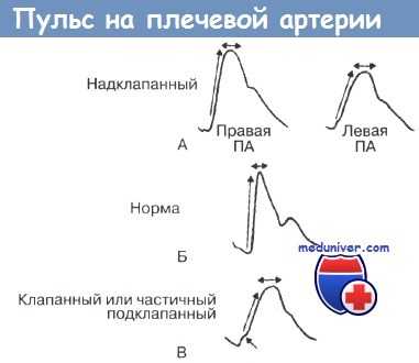 Пульс на плечевой артерии в норме и при патологии