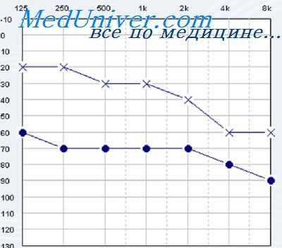 костная проводимость уха