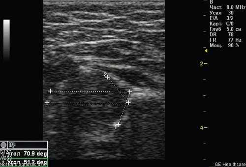 Эхограмма - тазобедренный сустав тип 1а
