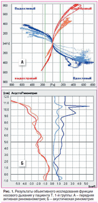 Рис. 1. Результаты объективного исследования функции носового дыхания у пациента Т. 1-й группы: А - передняя активная риноманометрия; Б - акустическая ринометрия