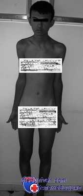 синдром шерешевского тернера