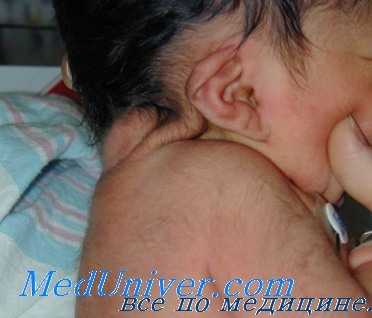 синдром шерешевского-тернера