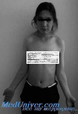 синдром шерешевского-тернера