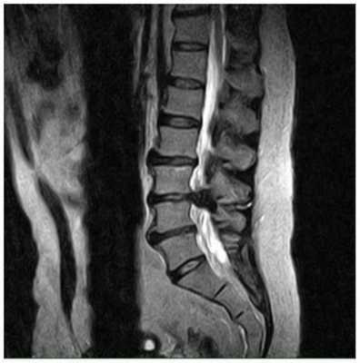 мрт позвоночника