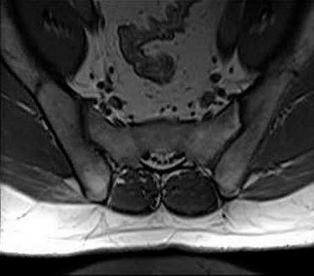 что показывает мрт пояснично-крестцового отдела