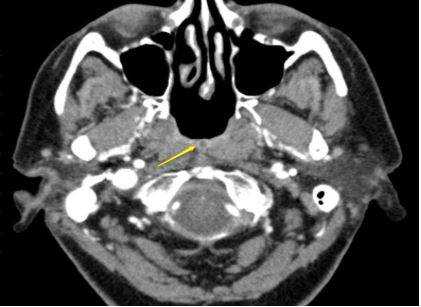 Снимок - Стрелка: четкие контуры кисты Торнвальда на КТ