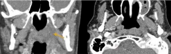 Рак носоглотки, с распространением на окологлоточное пространство (стрелкой указана зона инвазии)