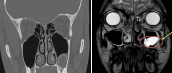  КТ-снимок одонтогенной кисты