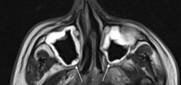 На снимке концентрическая воспалительная гипертрофия