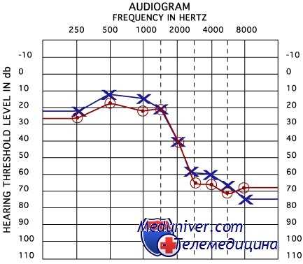 тональная аудиометрия при головокружении