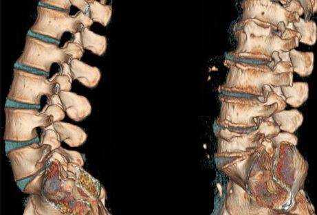 КТ поясничного отдела позвоночника