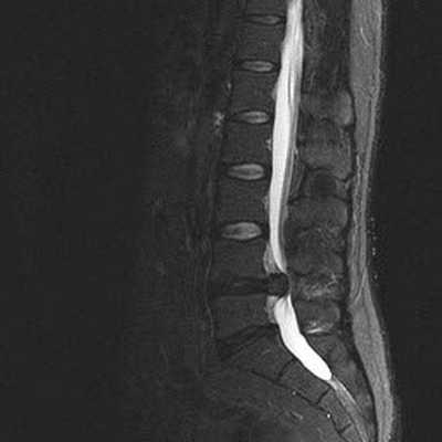 МРТ поясницы