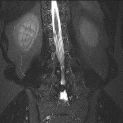МРТ снимок грыжи