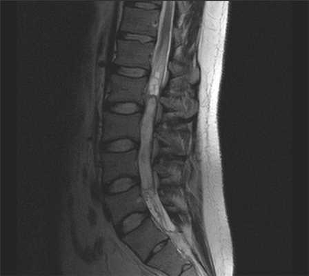 КТ поясничного отдела позвоночника