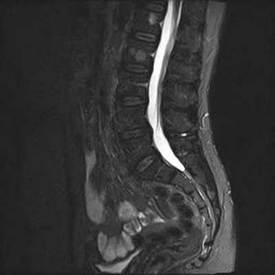 Гемангиомы на снимке МРТ