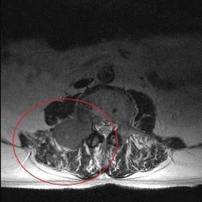 Опухолевое образование на МРТ