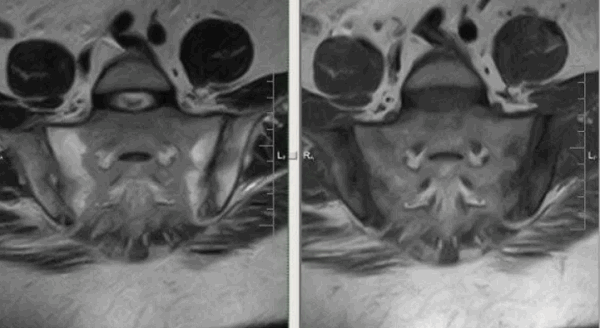 МРТ крестцово-подвздошных сочленений
