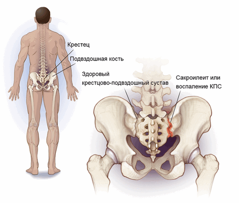 крестцово-подвздошные сочленения