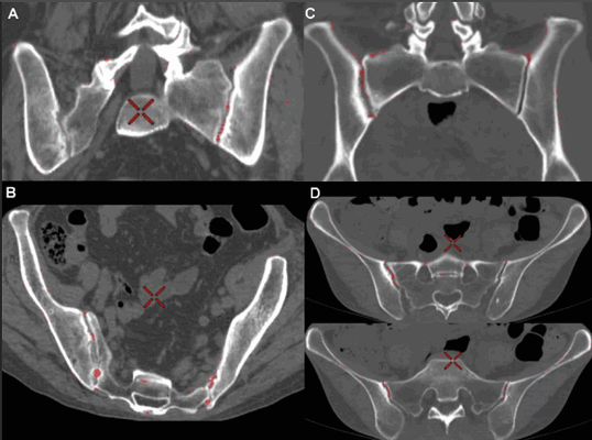 МРТ крестцово-подвздошных сочленений, что показывает
