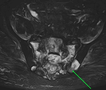 МРТ крестцово-подвздошных сочленений, что показывает