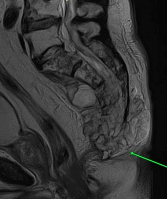 МРТ крестцово-подвздошных сочленений