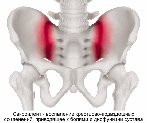 Сакроилеит