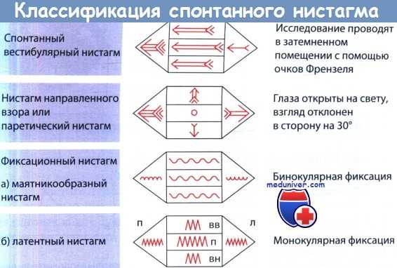 Классификация спонтанного нистагма