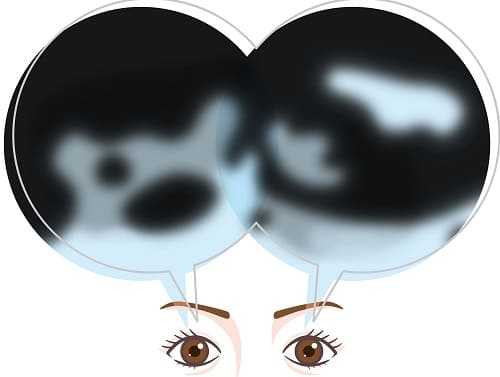 Нарушения зрения с правого и левого глаза