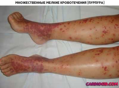 тромбоцитопеническая-пурпура