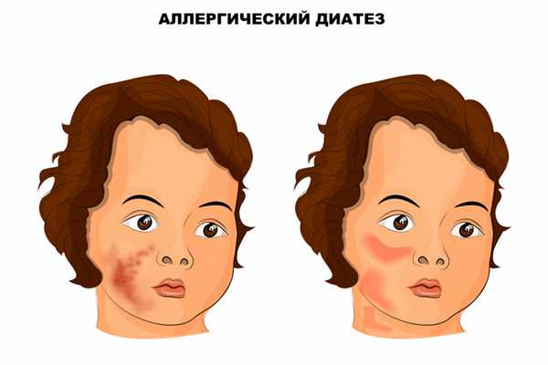 Аллергический диатез.jpg