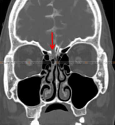 При компьютерной томографии костей черепа с цистернографией визуализируется костный дефект правой решетчатой пластинки (указано красной стрелкой).