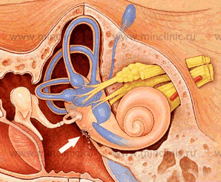 Разрыв перепонки круглого окна в стенке костного лабиринта, отделяющего полость среднего уха от полости улитки, лежит ниже овального окна, закрытого слуховой косточкой. Может быть истоником ушной спонтанной ликвореи.