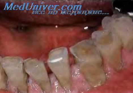 Стирание зубов