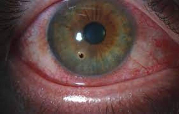 Инородное тело роговицы